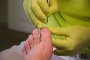 Toenail Surgery